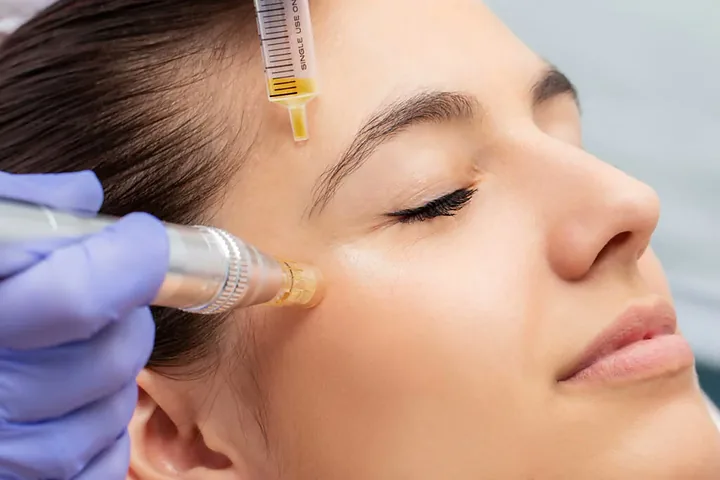 Un tratamiento facial PRP con microagujas