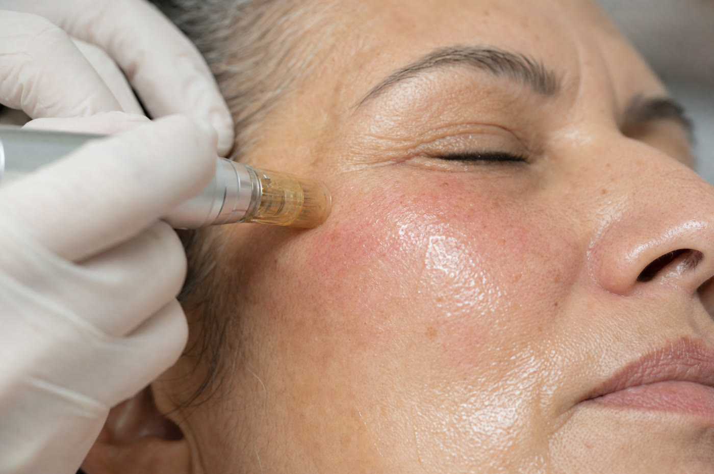 Close-up of a PRP microneedling facial in progress at Metropolitan Medical Centers