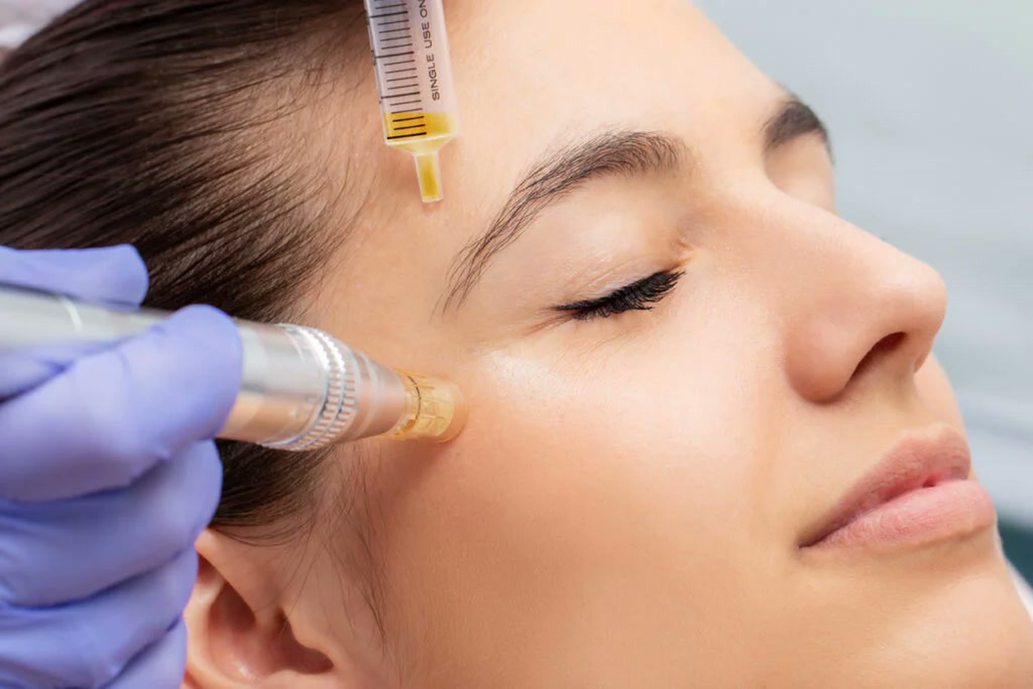 Close-up of a PRP facial rejuvenation treatment: platelet-rich plasma applied to the skin with a microneedling pen