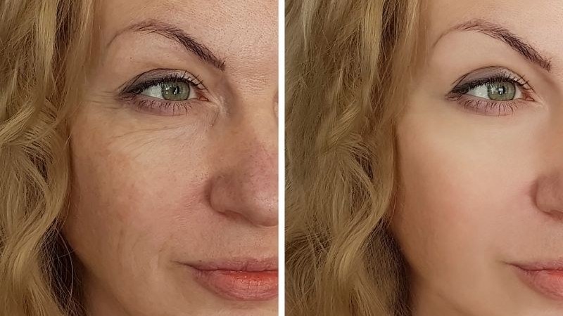 Reference before and after photograph showing smoother skin texture and softer fine lines
